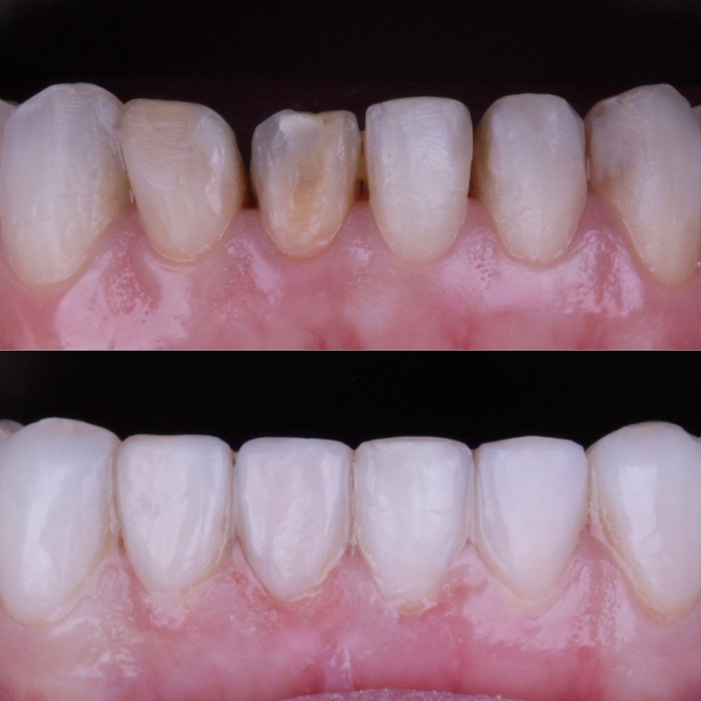 Antes e depois de acréscimo de resina