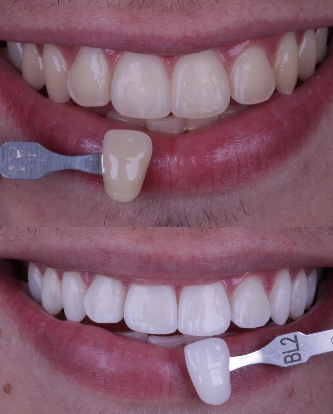 Antes e depois de clareamento dental