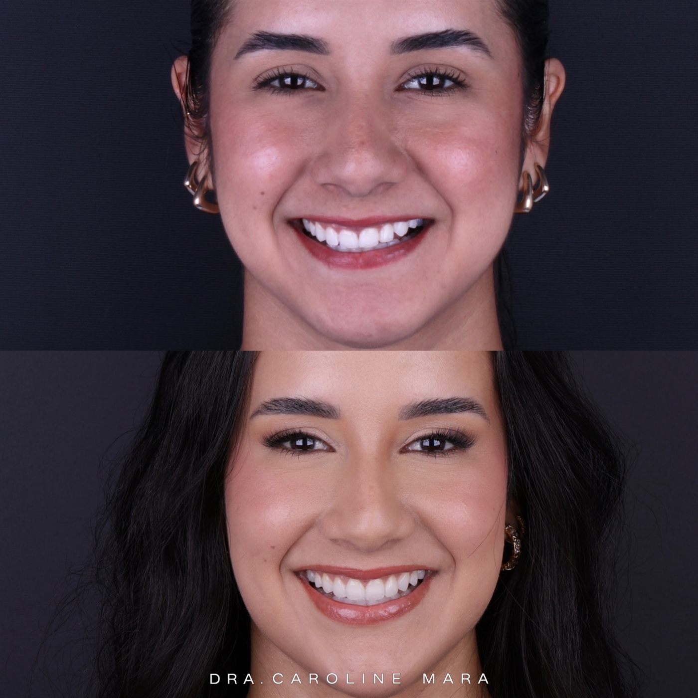 Antes e depois de facetas em resina