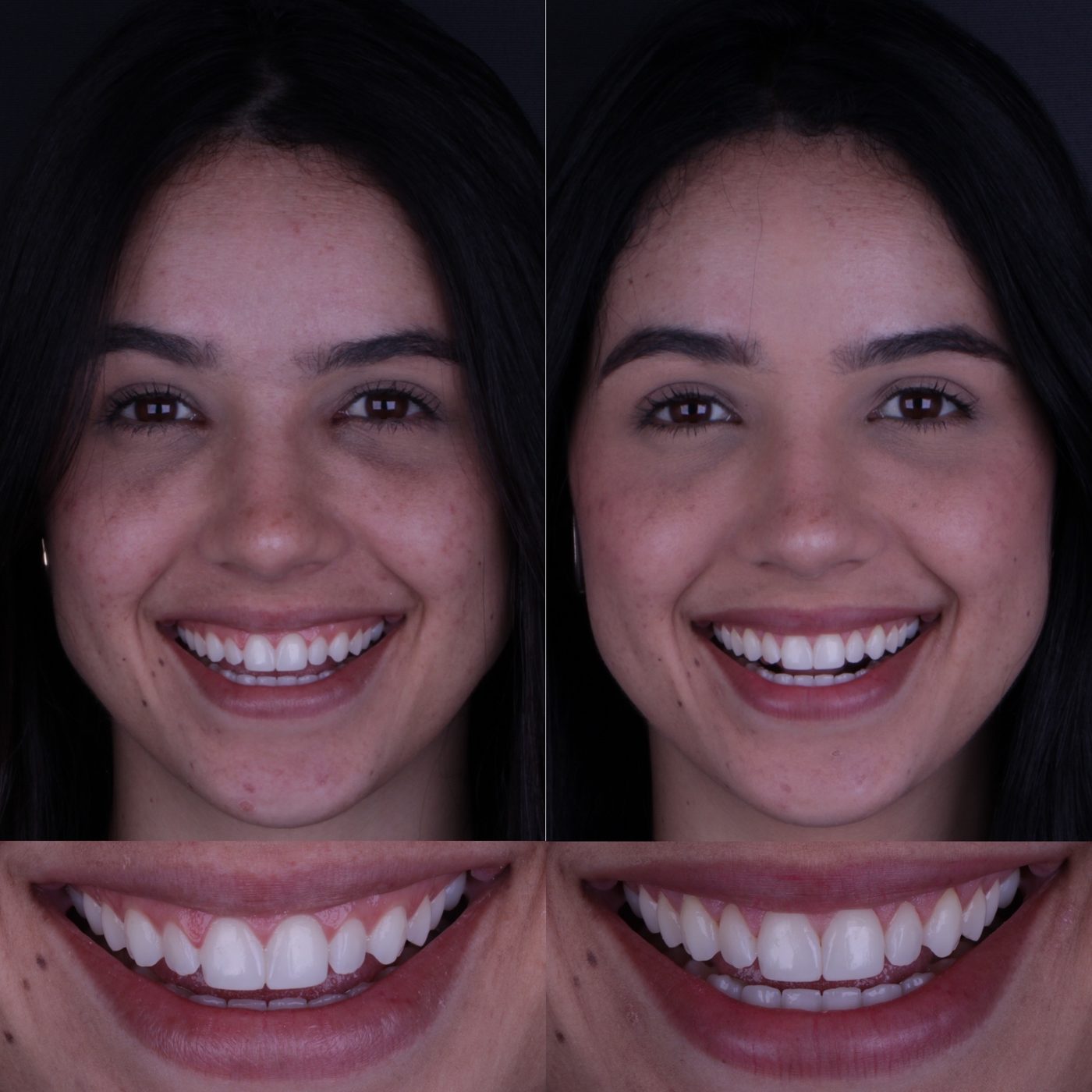 Antes e depois de gengivoplastia
