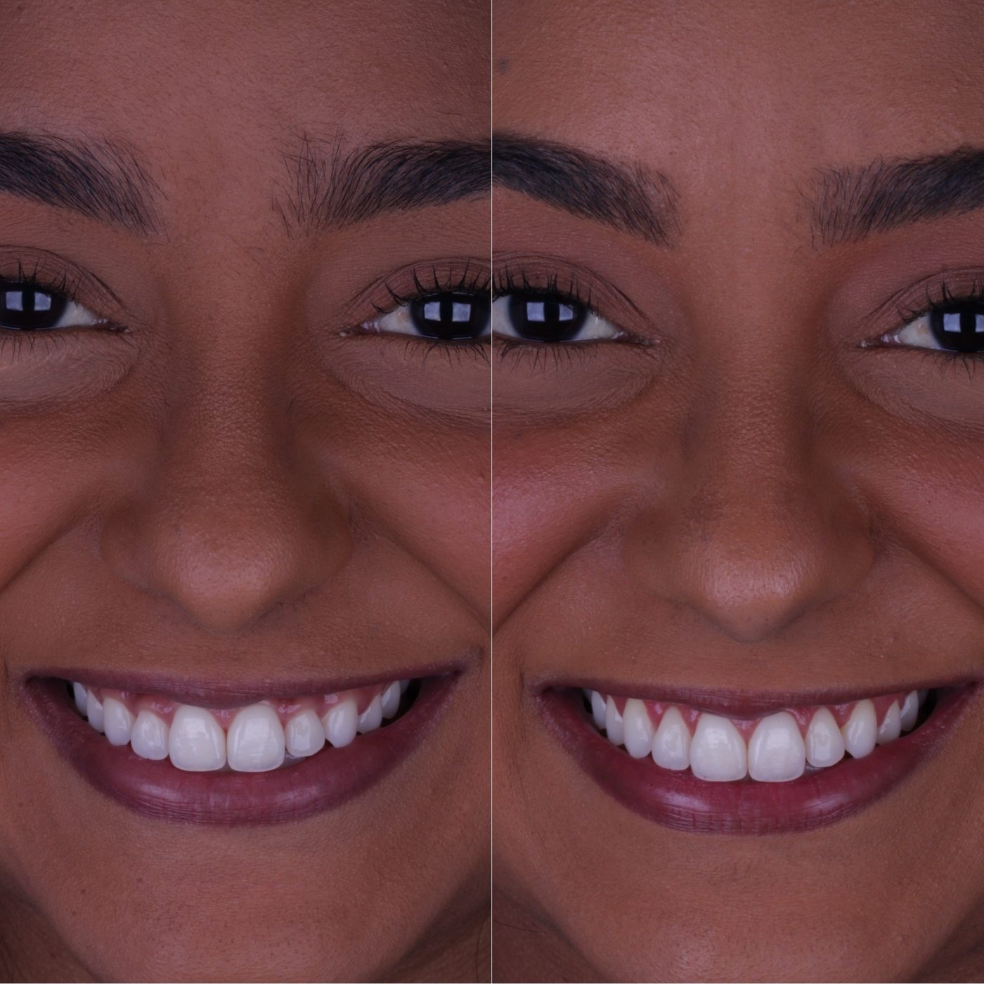 Antes e depois de gengivoplastia