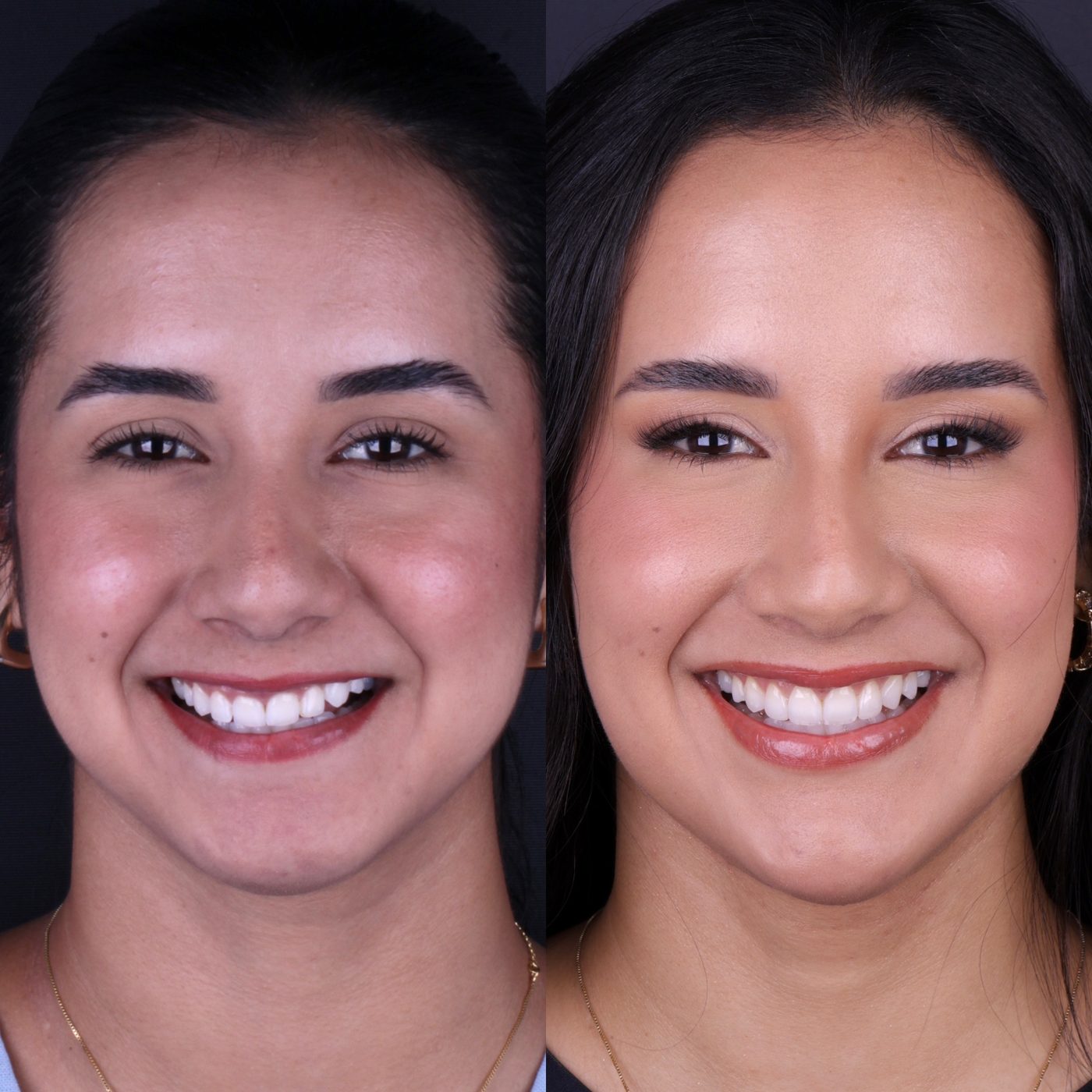 Antes e depois de harmonização full face, toxina botulínica e facetas em resina