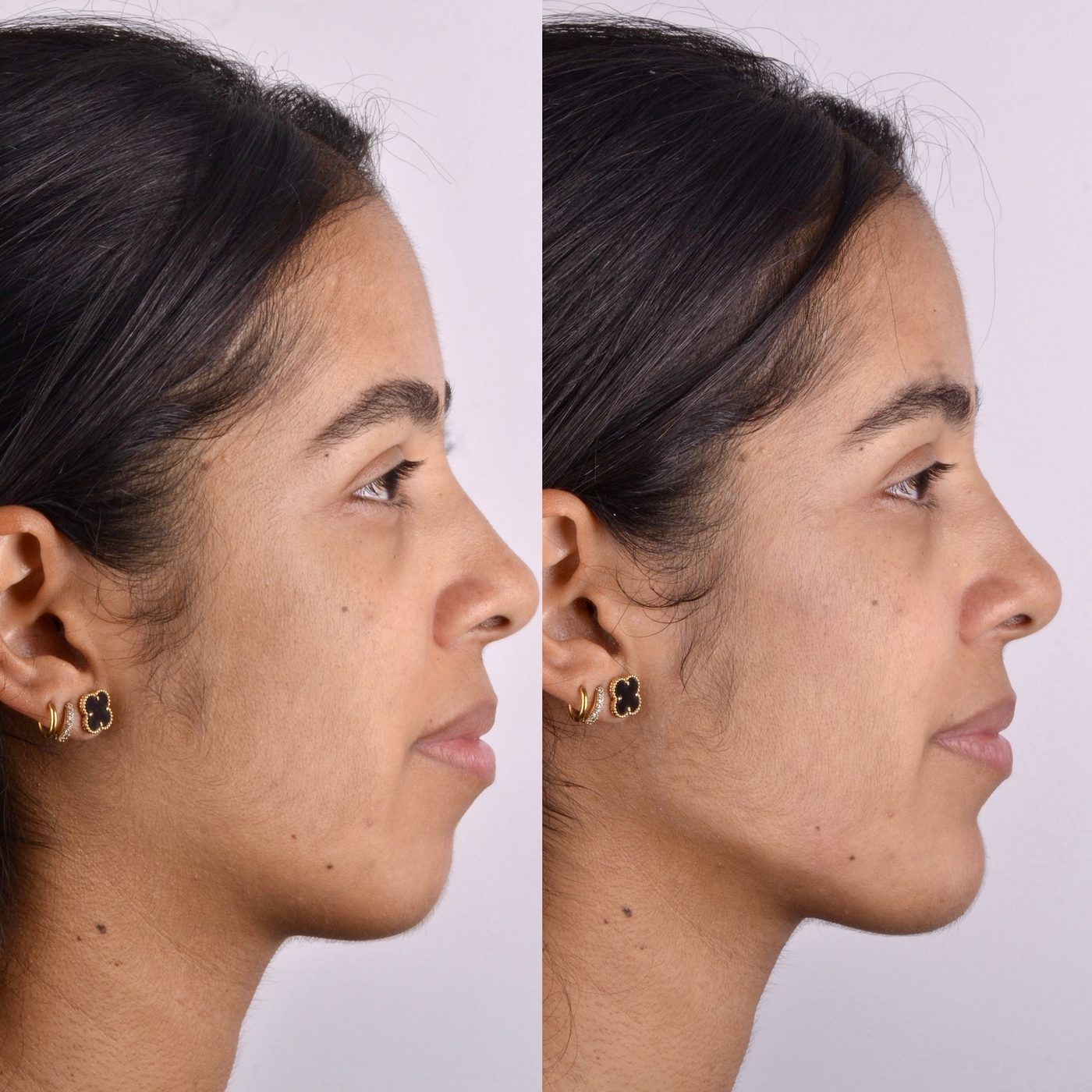 Antes e depois de harmonização facial, vista de perfil