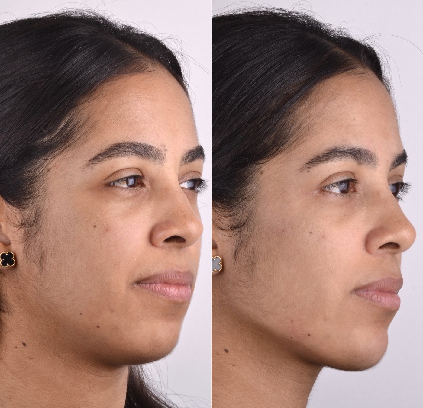 Antes e depois de harmonização facial, vista em três quartos