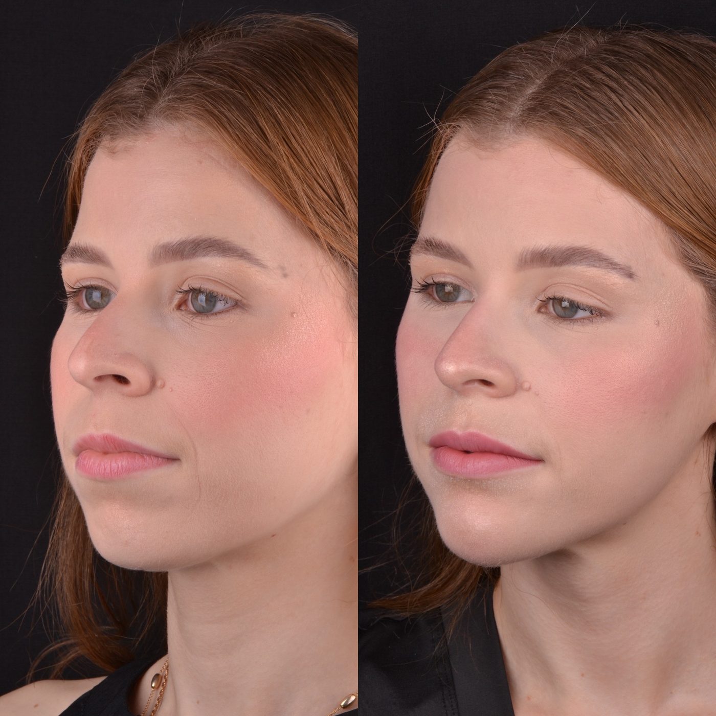 Antes e depois de harmonização do mento
