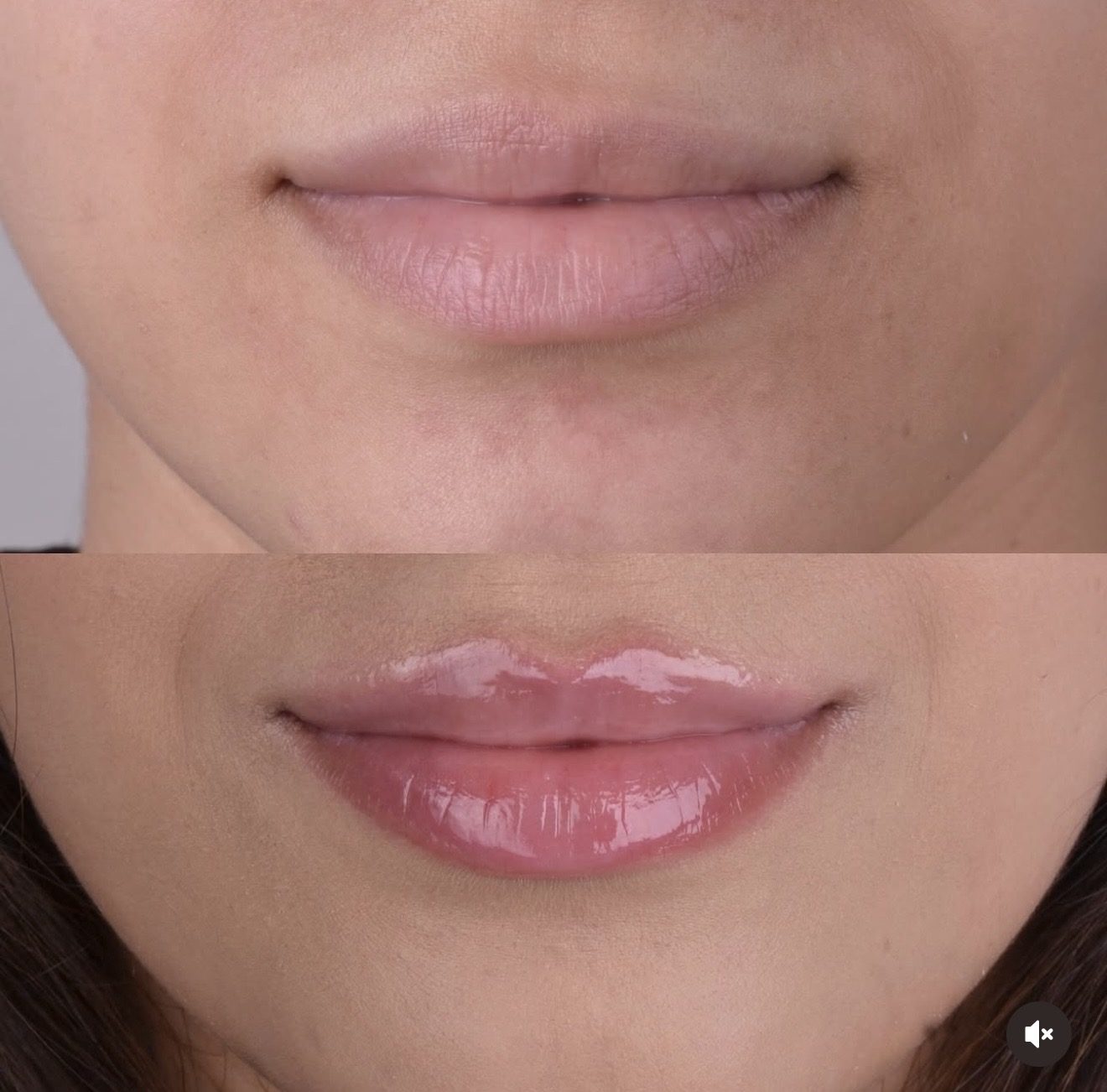 Antes e depois de preenchimento labial