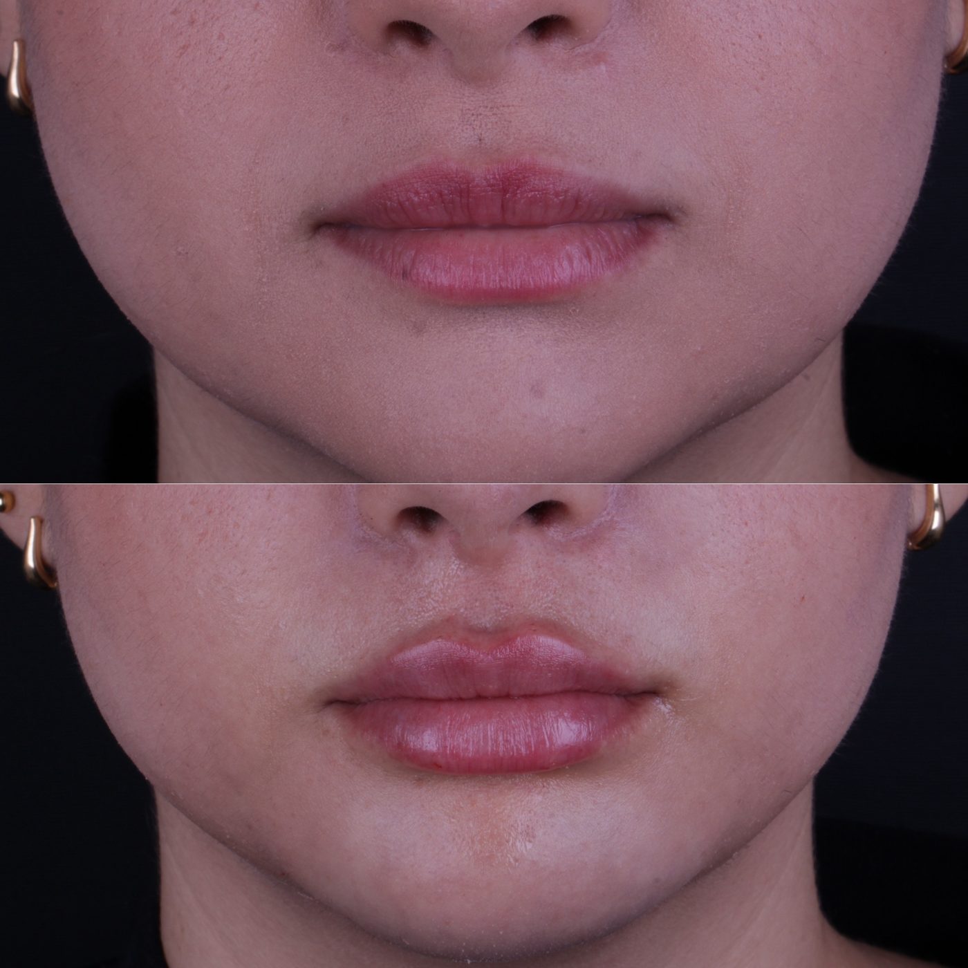 Antes e depois de preenchimento labial