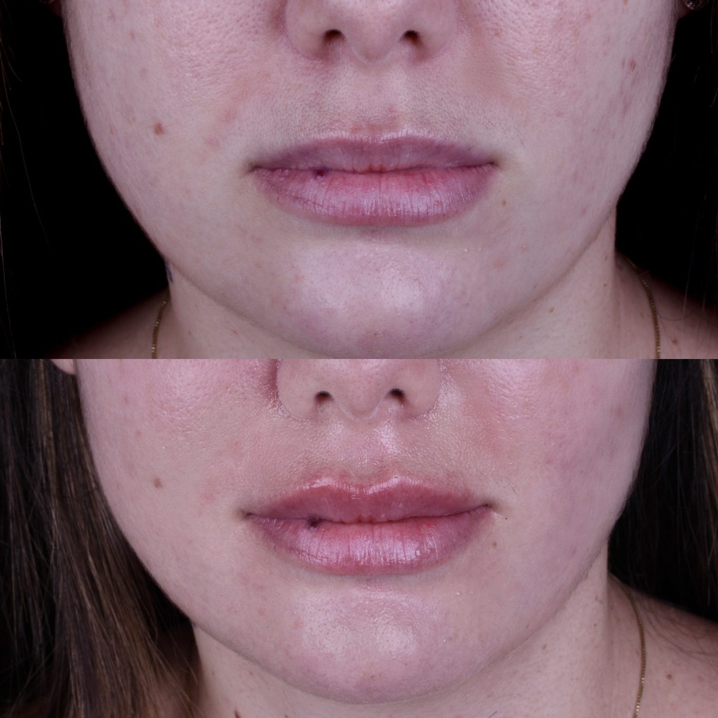 Antes e depois de preenchimento labial