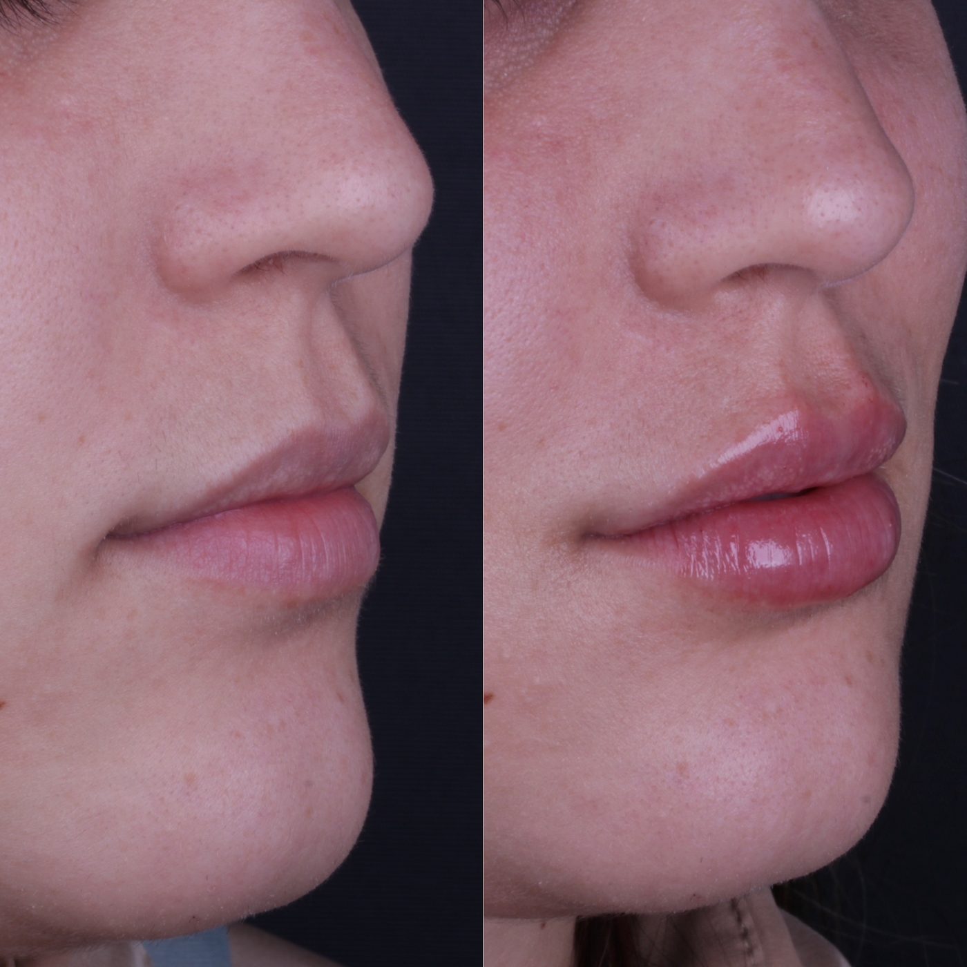Antes e depois de preenchimento labial, vista lateral