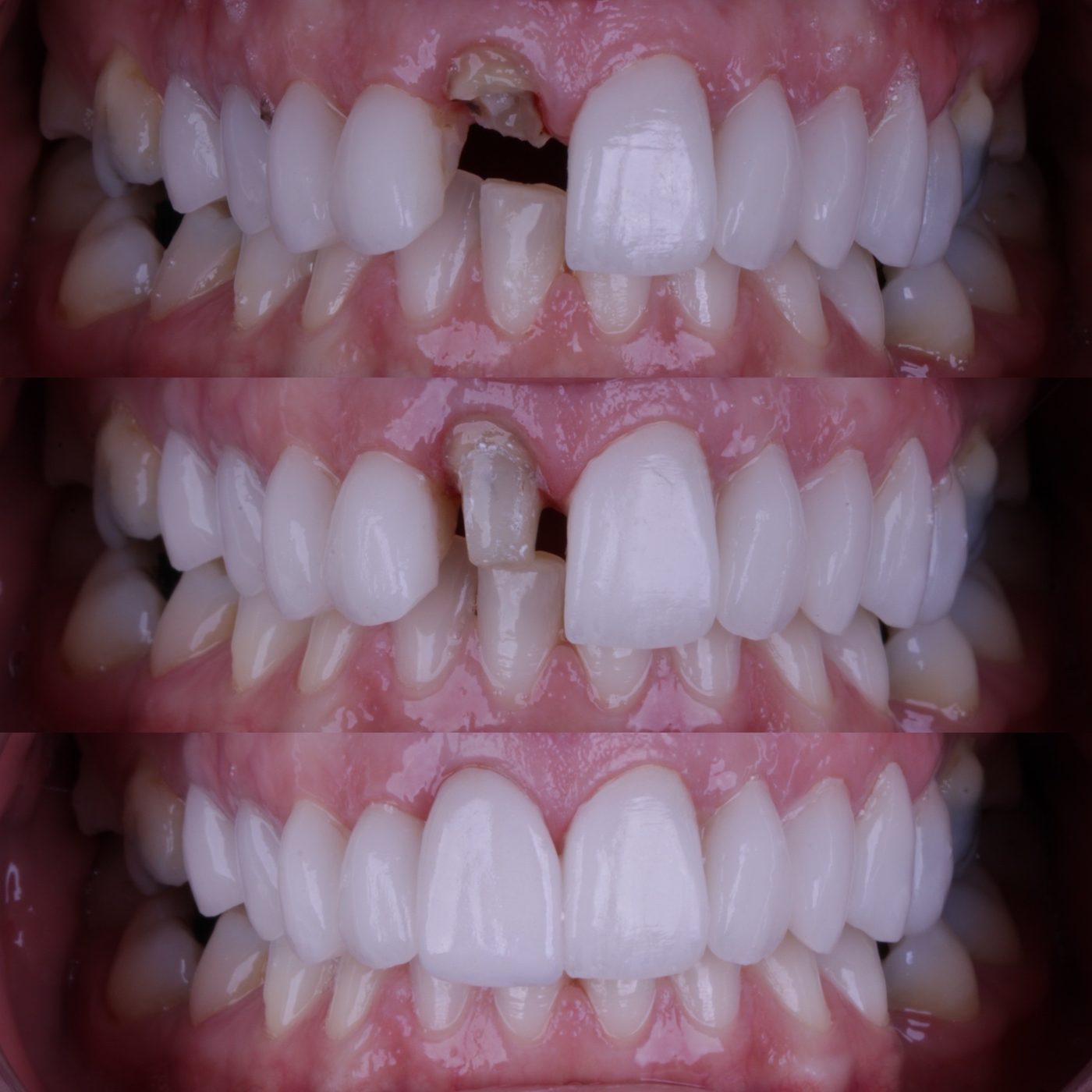 Sequência de reabilitação com coroa dentária: dente fraturado, preparo e coroa final